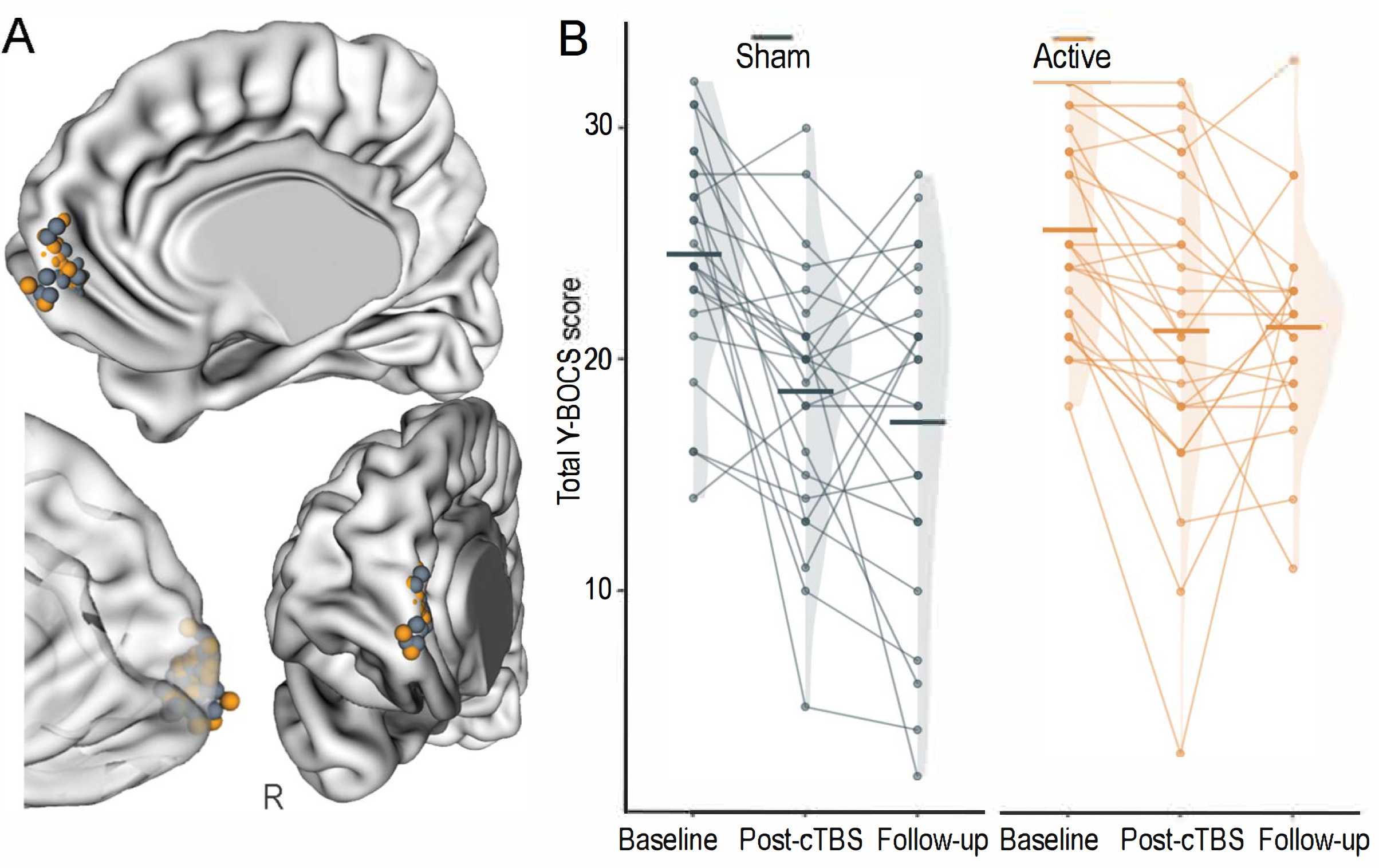 TMS Clinical Trial